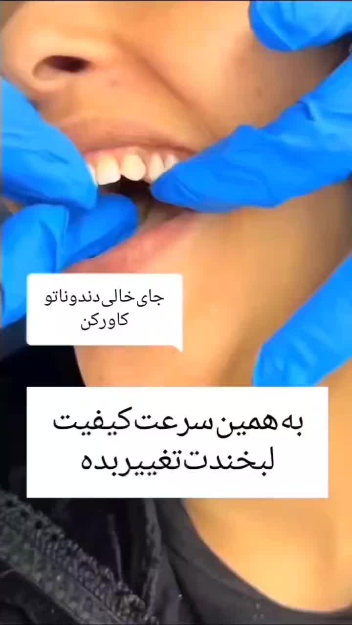 ساخت پروتز دندان متحرک|خدمات آرایشگری و زیبایی|قم, شهرک طالقانی|دیوار