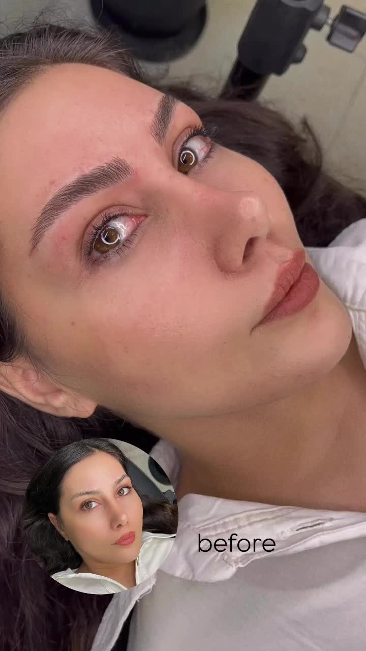 میکروبلیدینگ و فیبروز کرکی و موئی|خدمات آرایشگری و زیبایی|فردیس, فردیس|دیوار