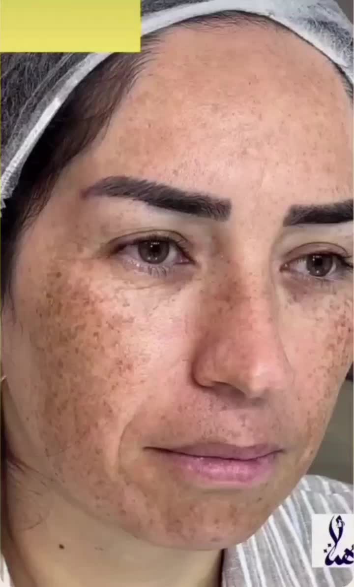 جشنوار یلدا درمان تضمینی کک ومک/لک/خال/فقط در1جلسه|خدمات آرایشگری و زیبایی|اصفهان, باغ زیار|دیوار