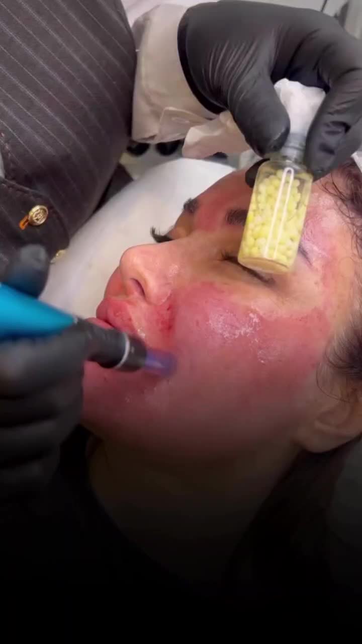 آنزیم بینی گوشتی غبغب پلاسما تراپی،مزونیدلینگ|خدمات آرایشگری و زیبایی|شیراز, محراب|دیوار