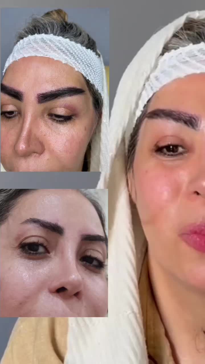 کاشت ابرو با دو تکنیک نانو گرافت و فیش تیل|خدمات آرایشگری و زیبایی|شهریار, شهرک وائین|دیوار