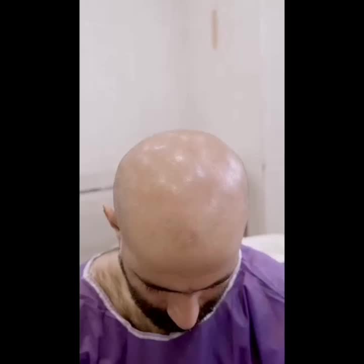اقتصادی ترین کلینیک کاشت مو و ابرو در تهران/ اقساط|خدمات آرایشگری و زیبایی|تهران, سعادت‌آباد|دیوار