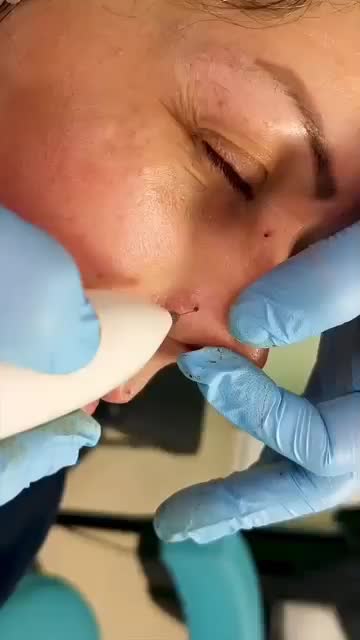 حذف خال، کک و مک و زوائد پوستی با کمترین قیمت|خدمات آرایشگری و زیبایی|یاسوج, |دیوار