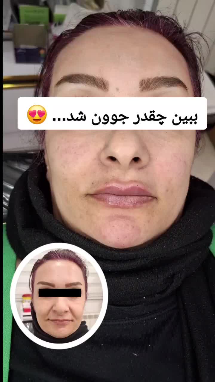 جشنواره مدل و آموزش ژل/ بوتاکس/فیلر بادی در کلینیک|خدمات آرایشگری و زیبایی|شیراز, قدوسی غربی|دیوار