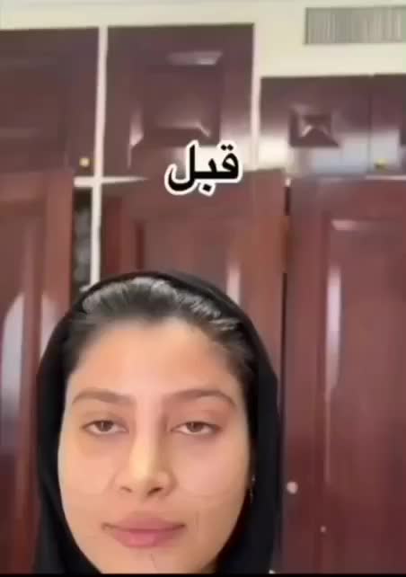 ژل لب بوتاکس فیلر مزو ژل یانگ فیس پی ارپی نخ لیفت|خدمات آرایشگری و زیبایی|مشهد, احمدآباد|دیوار