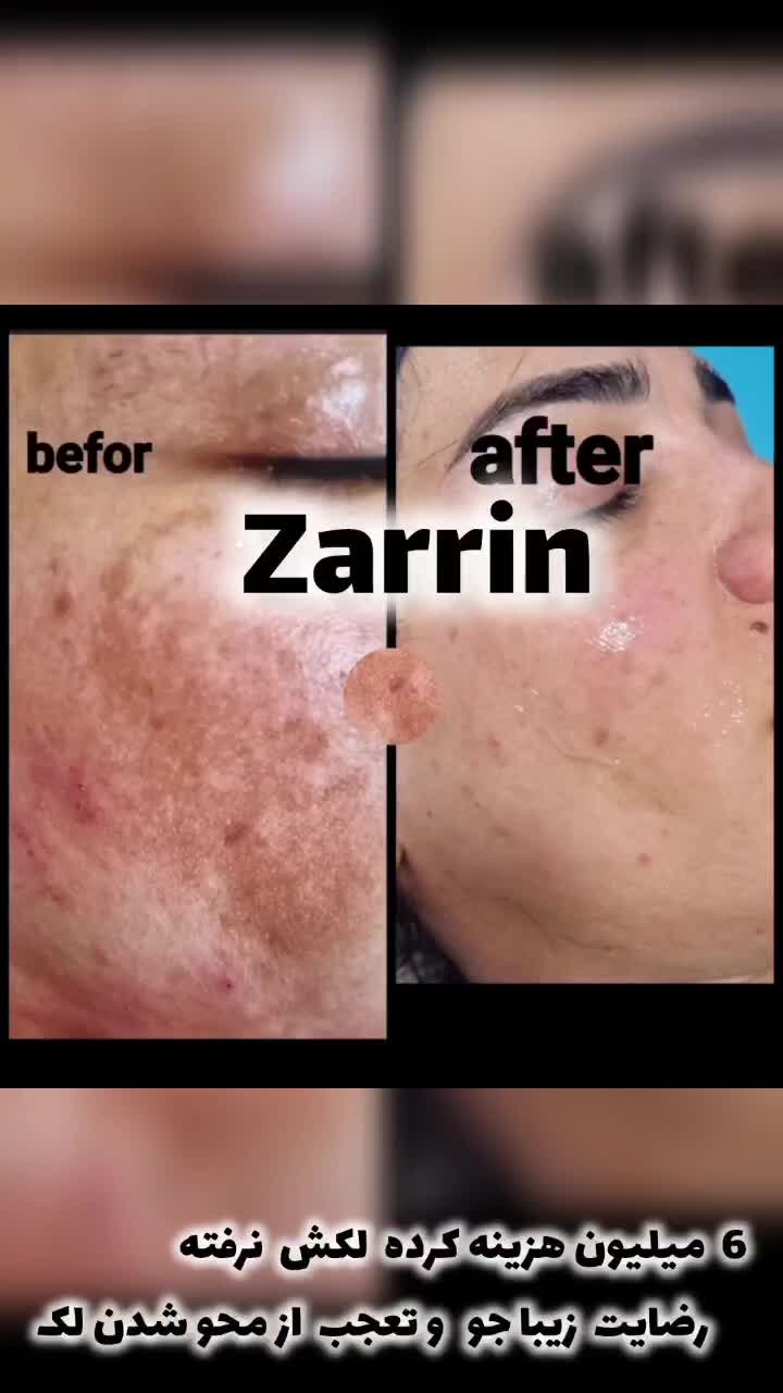 خدمات پاکسازی پوست ، پلکسر، میکرونیدلینگ|خدمات آرایشگری و زیبایی|تهران, پاسداران|دیوار