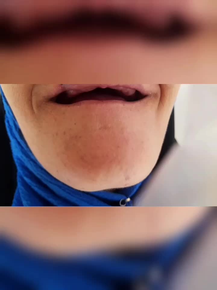 دندان مصنوعی متحرک|خدمات آرایشگری و زیبایی|شهرکرد, |دیوار