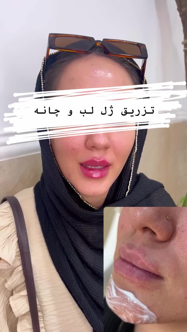ژللب۱/۲۰۰بوتاکس مصپورت۵۹۹لیزر فول بادی۳۹۹|خدمات آرایشگری و زیبایی|کاشان, بهشتی|دیوار