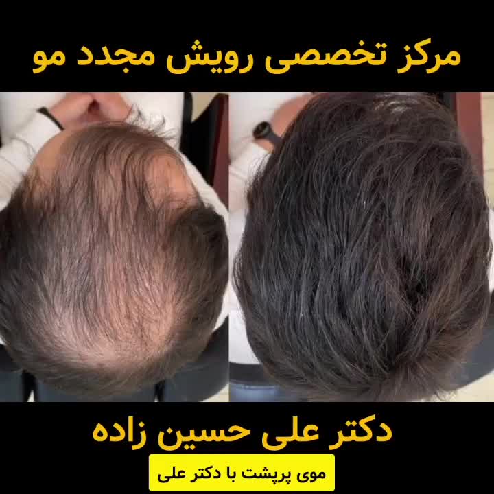 مزو تراپی پی آر پی رفع ریزش مو با دفترچه بیمه پرند|خدمات آرایشگری و زیبایی|پرند, |دیوار