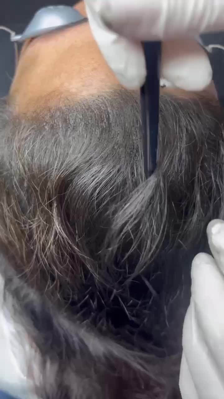 میکرواسکالپ سر|خدمات آرایشگری و زیبایی|گرگان, |دیوار