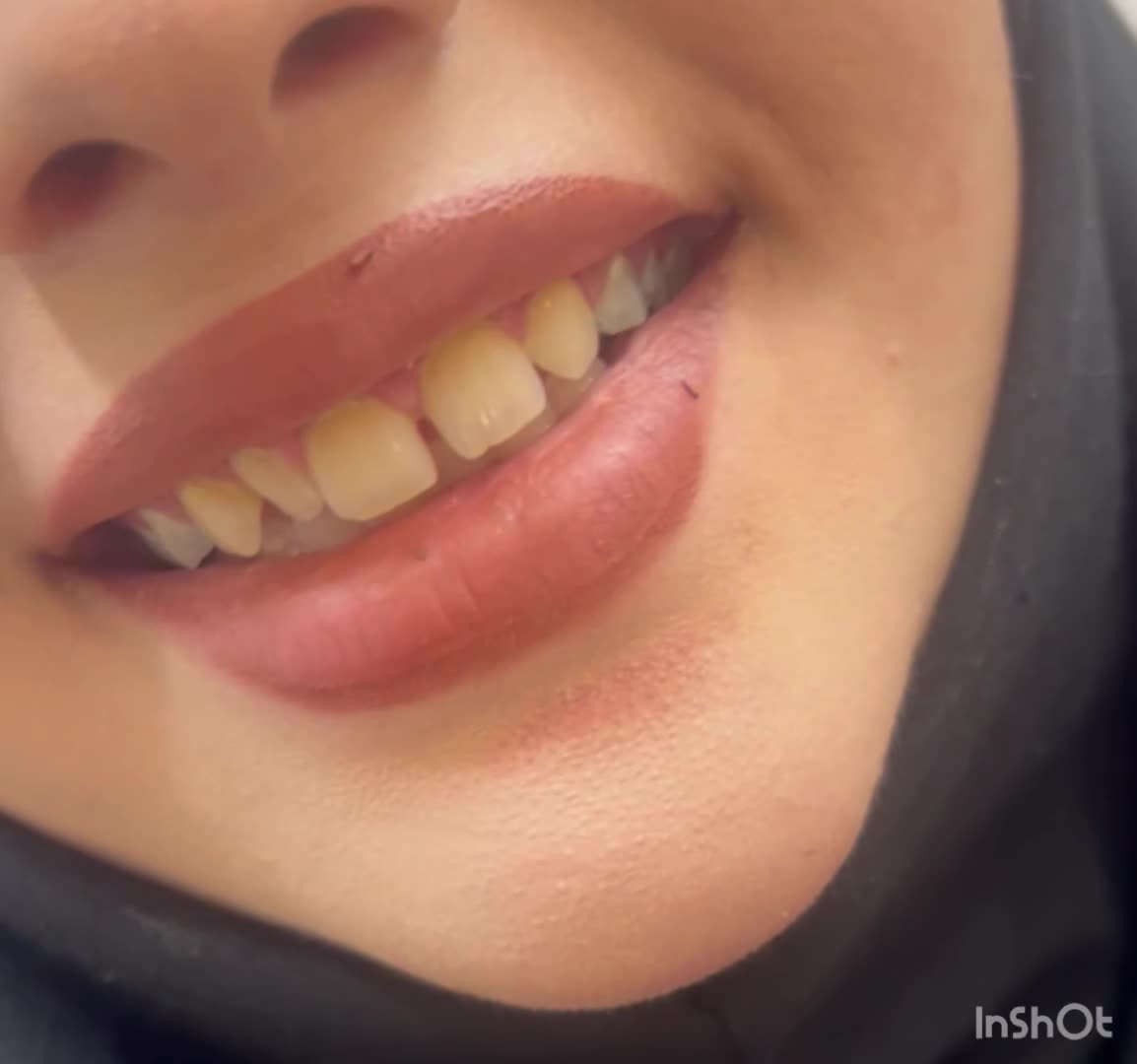 کامپوزیت ونیر دندان هر واحد ۱/۵۰۰ با ضمانت|خدمات آرایشگری و زیبایی|اصفهان, احمدآباد|دیوار