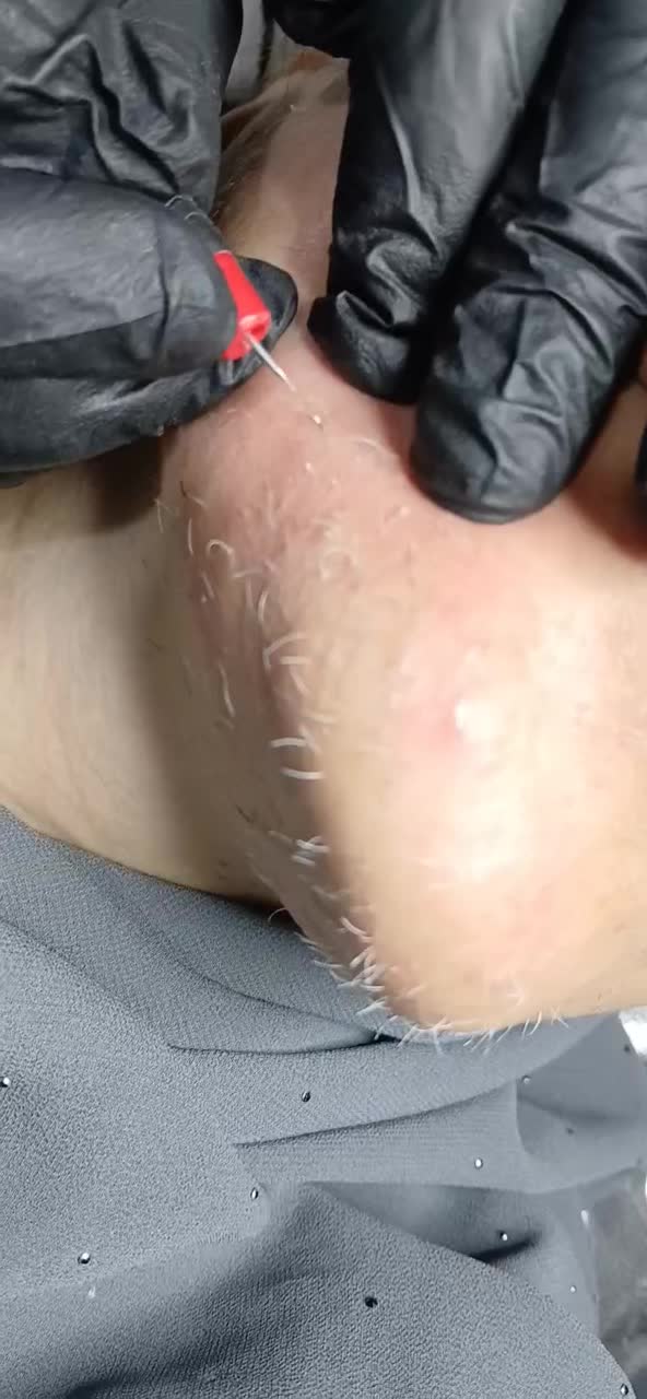 الکترولیز برای همیشه از شر موهای سفید خلاص شوید|آرایشی، بهداشتی، درمانی|ایلام, |دیوار