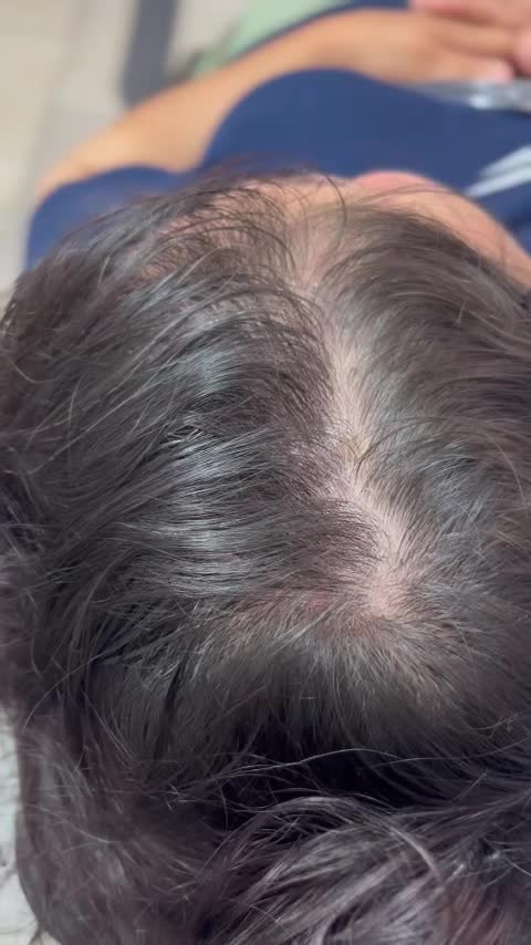 مزوتراپی مو مزونیدلینگ موفقط ۶۵۰ریزش مو رویش مجدد|خدمات آرایشگری و زیبایی|قائم‌شهر, |دیوار