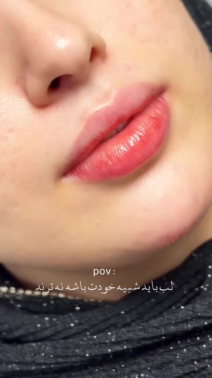 ژل بوتاکس فیلر زاویه ژل لب مطب پزشک|خدمات آرایشگری و زیبایی|قم, ارم|دیوار