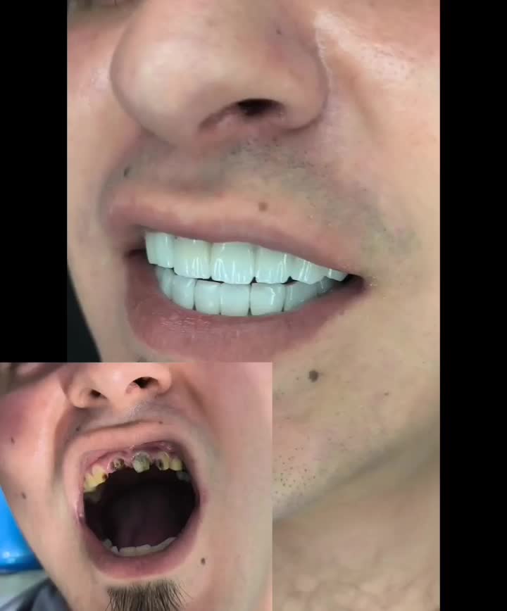 کامپوزیت دندان|خدمات آرایشگری و زیبایی|دورود, |دیوار