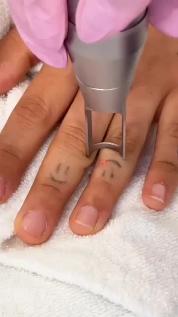 رفع تیرگی بدن حذف تتو صورت و بدن. کربن تراپی|خدمات آرایشگری و زیبایی|تربت‌حیدریه, کاشانی|دیوار