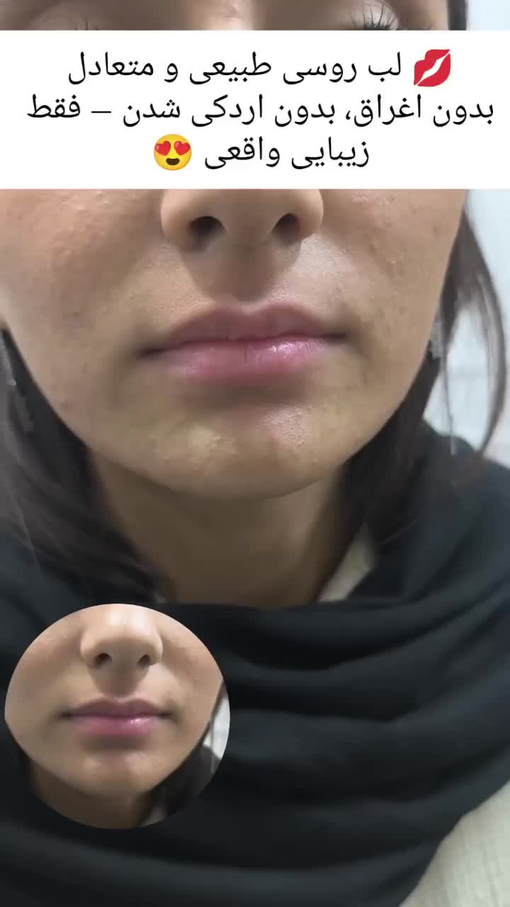 ٪50 آفر مزو prp بوتاکس فیلر لب زاویه سازی فیلرچانه|خدمات آرایشگری و زیبایی|مشهد, وکیل‌آباد|دیوار