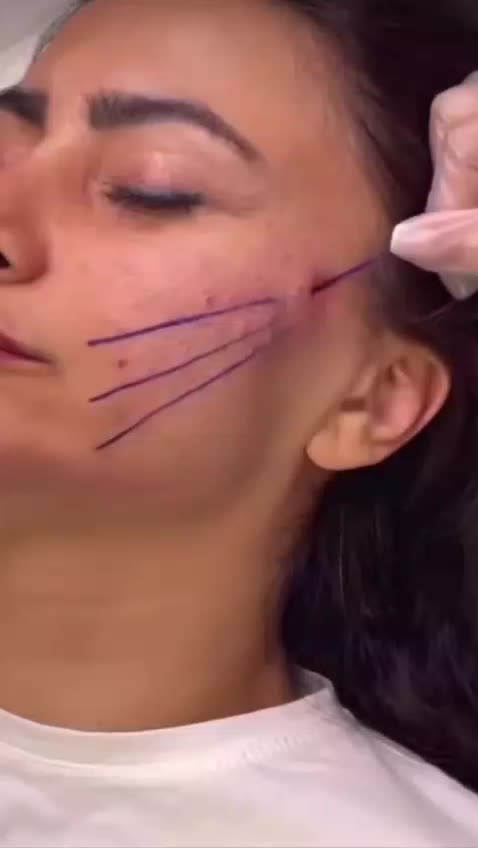 ژل بوتاکس ژل لب فیلر بادی نخ لیفت فیلر زیر چشم|خدمات آرایشگری و زیبایی|اصفهان, جلفا|دیوار
