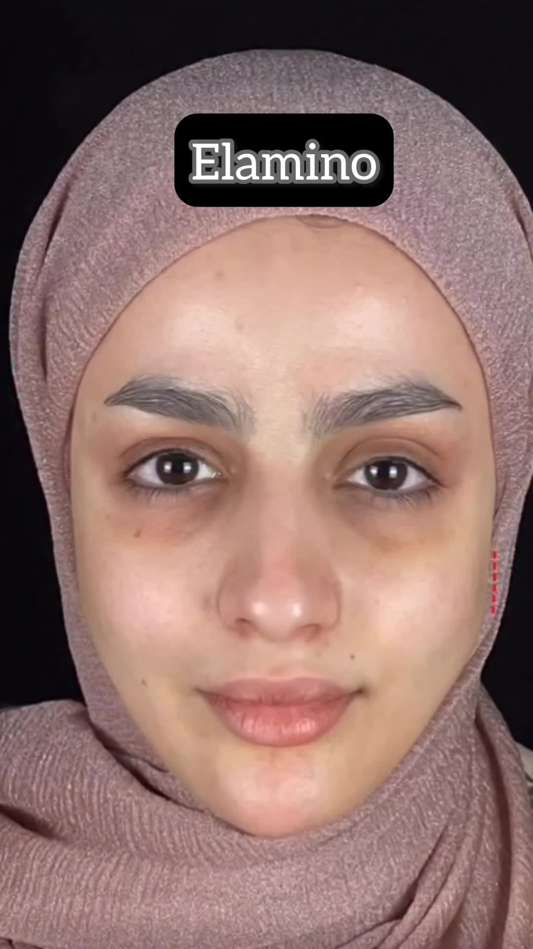 تزریق ژل بوتاکس فیلر در کلینیک زیبایی تهران|خدمات آرایشگری و زیبایی|تهران, یافت آباد جنوبی|دیوار