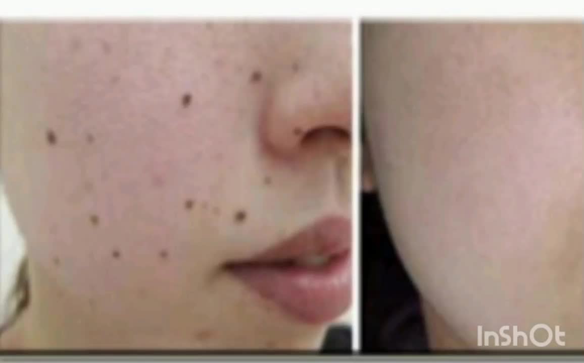 لیزرخال وزگیل منگوله های گوشتی بدون درد|پزشکی|دورود, |دیوار