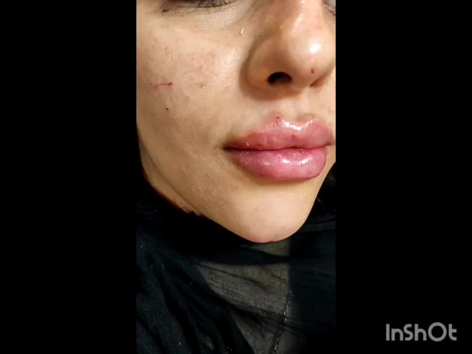 ژل وبوتاکس.چربی سوز.انزیم.فشیال.پیرسینگ|خدمات آرایشگری و زیبایی|اصفهان, احمدآباد|دیوار