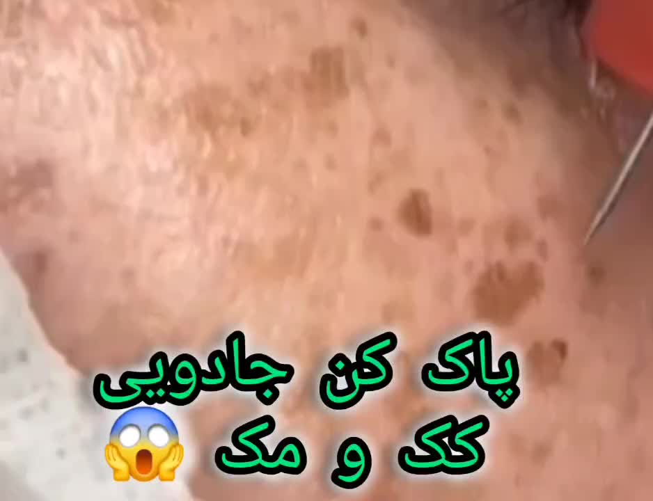 درمان لک ها و مشکلات پوست با بروزترین متد|خدمات آرایشگری و زیبایی|مشهد, سرافرازان|دیوار