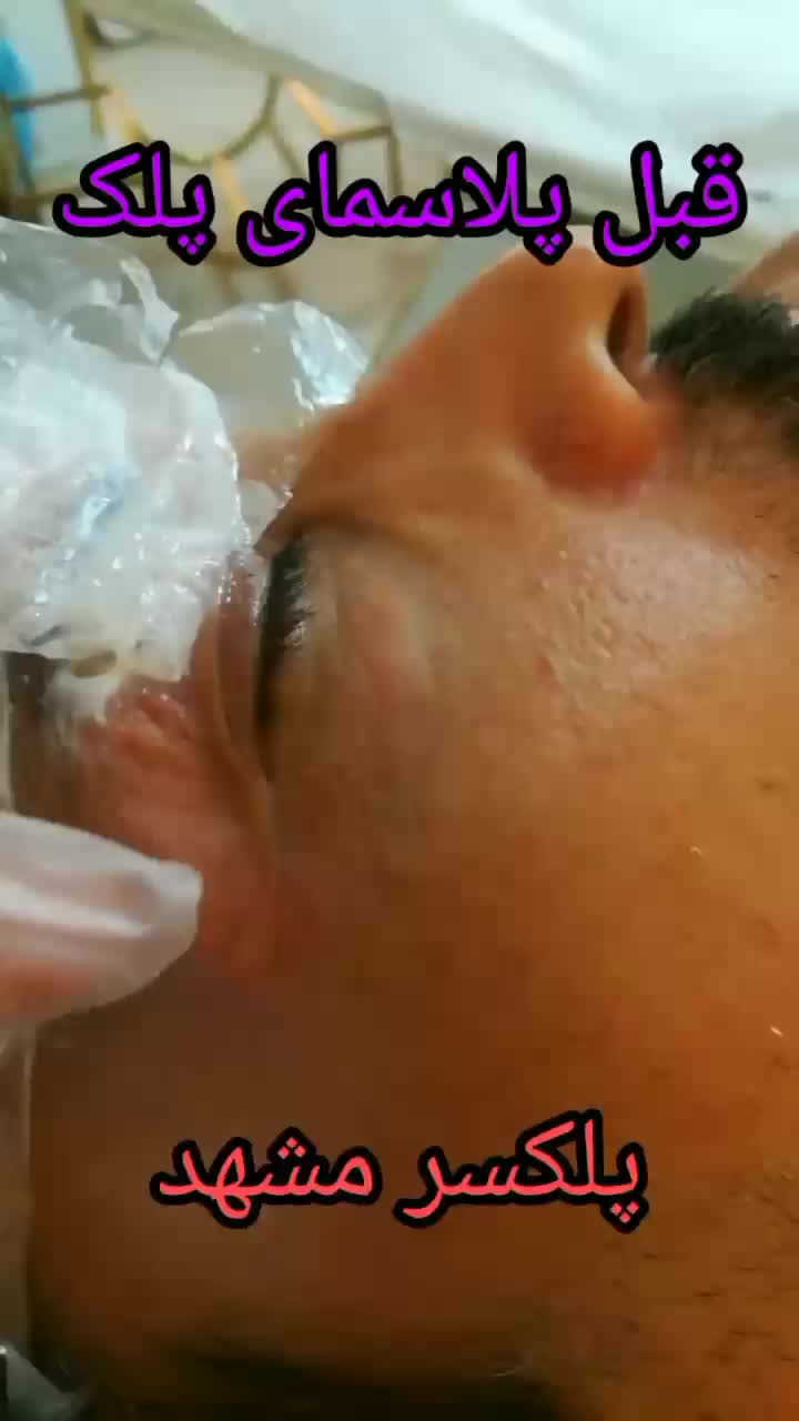 جوان سازی و لیفت به روش پلکسر بدون عمل جراحی|خدمات آرایشگری و زیبایی|مشهد, طلاب|دیوار
