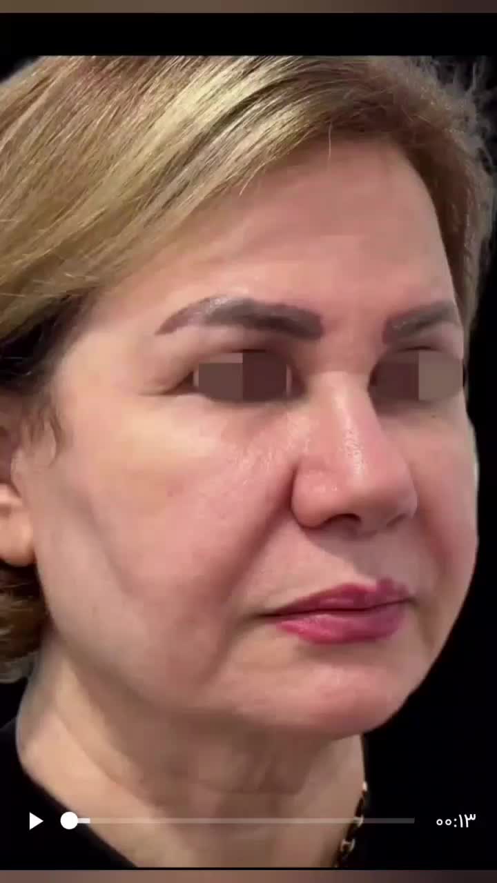 مرکز تخصصی جوانسازی اندولیفت/هایفو/لیفت فقط۸۹۰ت|خدمات آرایشگری و زیبایی|اصفهان, لاله|دیوار