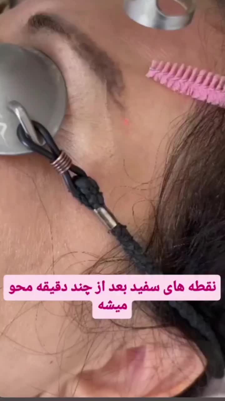 لیزر حذف تتو باپترو و ازاد|خدمات آرایشگری و زیبایی|بندر ماهشهر, |دیوار