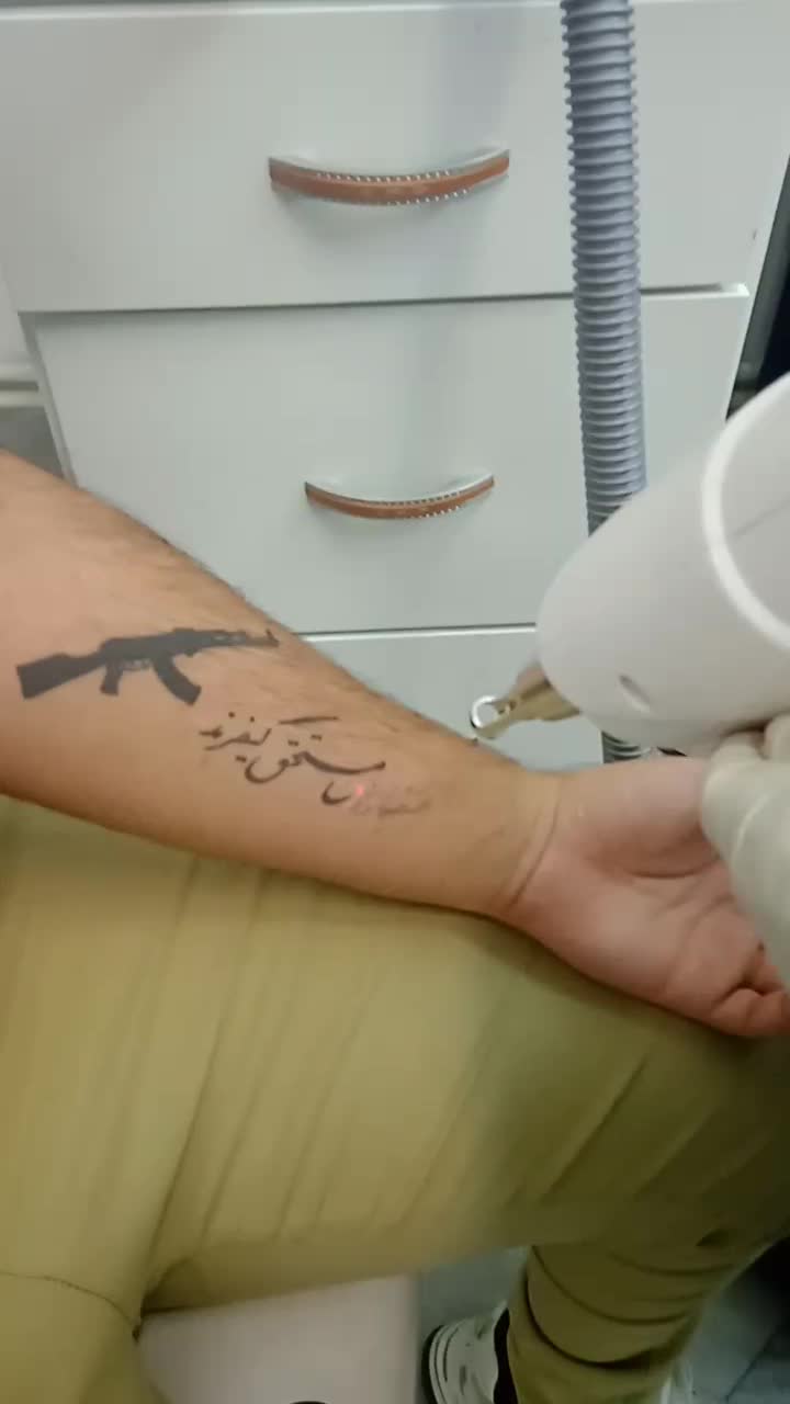 پاک کردن تتو با لیرز در مطب|خدمات آرایشگری و زیبایی|مشهد, احمدآباد|دیوار