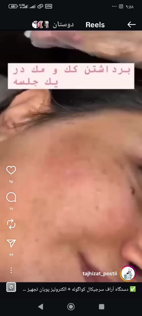 خال صورت/لکه های پوستی/لیزرموسفید/ریموتتو/بوتاکس|خدمات آرایشگری و زیبایی|نجف‌آباد, بازار|دیوار