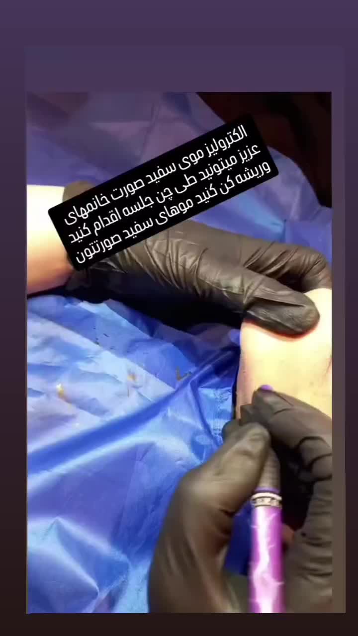 الکترولیز موی سفید وسیاه صورت بانوان فقط|خدمات آرایشگری و زیبایی|بروجرد, |دیوار