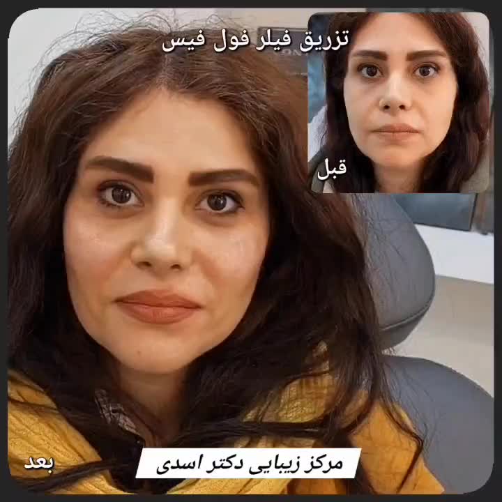 مرکز زیبایی دکتر اسدی (بوتاکس فیلر هایفو مزوتراپی)|خدمات آرایشگری و زیبایی|تهران, نیاوران|دیوار