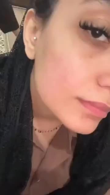 درمان جوش با هر منشایی|خدمات آرایشگری و زیبایی|دوگنبدان, |دیوار