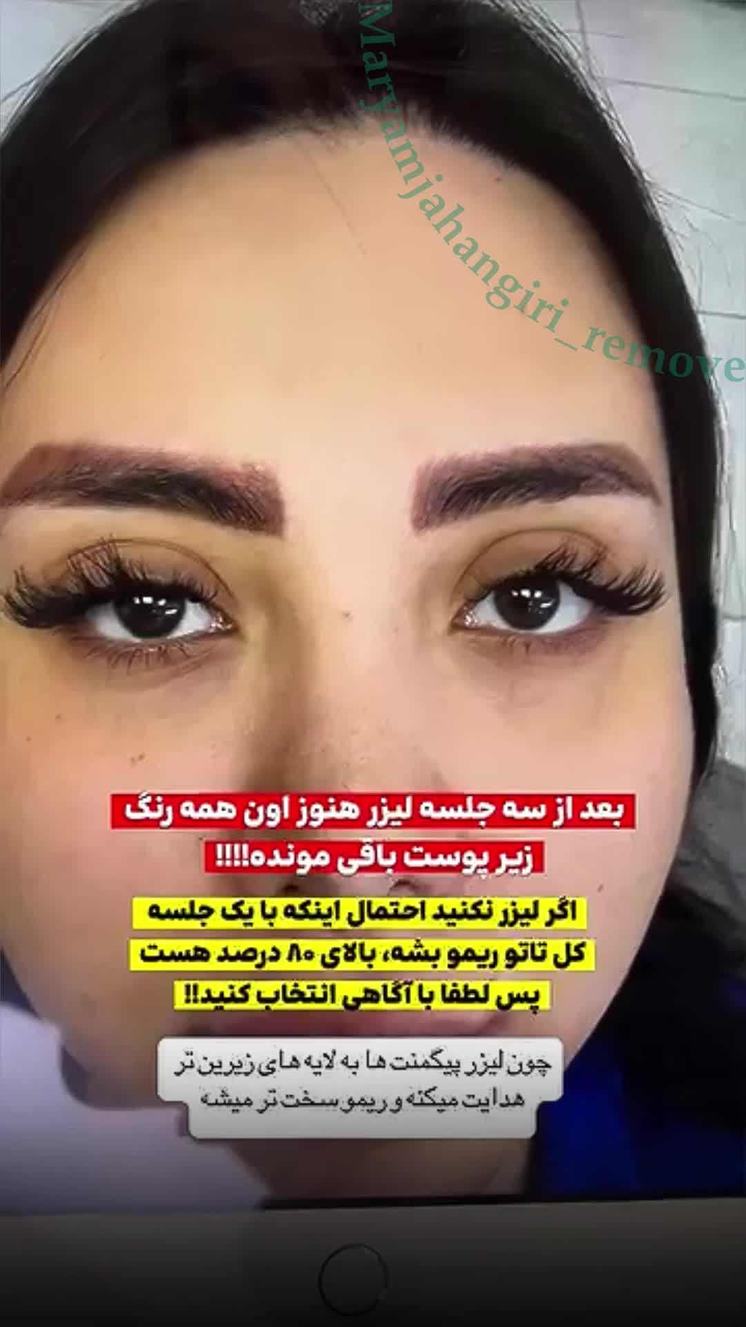 تخفیف ریموو تتو ابرو، خط چشم و لب در مرکز پوست غرب|خدمات آرایشگری و زیبایی|تهران, باغ فیض|دیوار